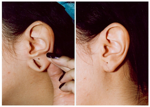ear lobe repair